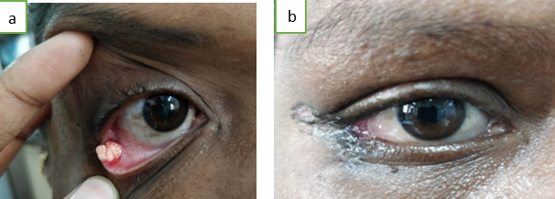 a: and b: Managed with Tenzel lateral advancement flap