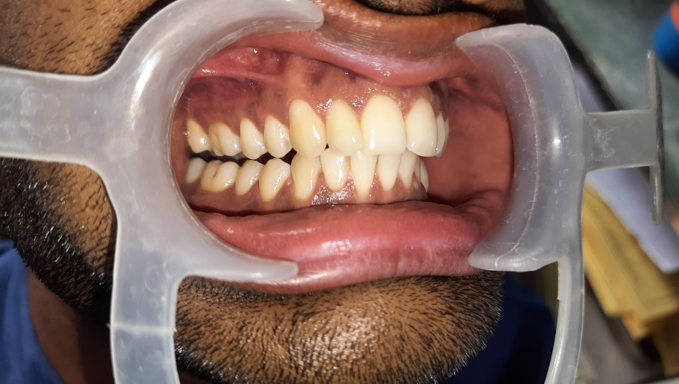 Canine protected occlusion