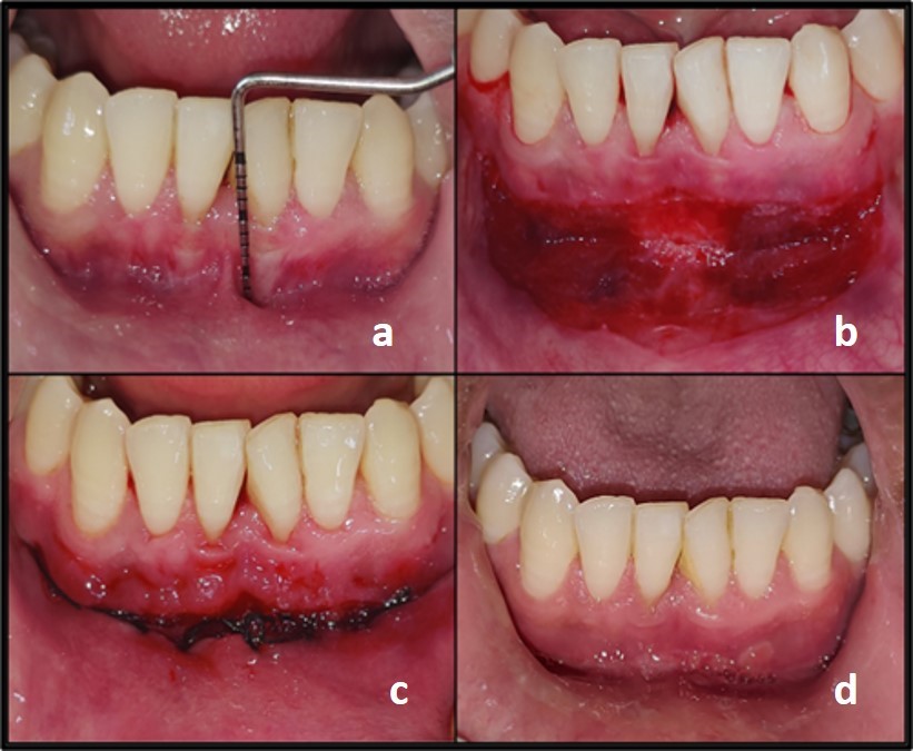 Clark’s technique of vestibuloplasty; a: Pre-operative view; b: Incision made and supraperiosteal dissection done; c: Suturing done; d: 21 days post-operative view.
