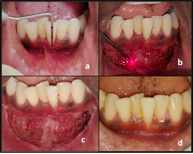 Laser vestibuloplasty; a: Pre-operative view; b: Vestibuloplasty using diode laser application; c: Immediate post-operative view; d: 21 days post-operative view