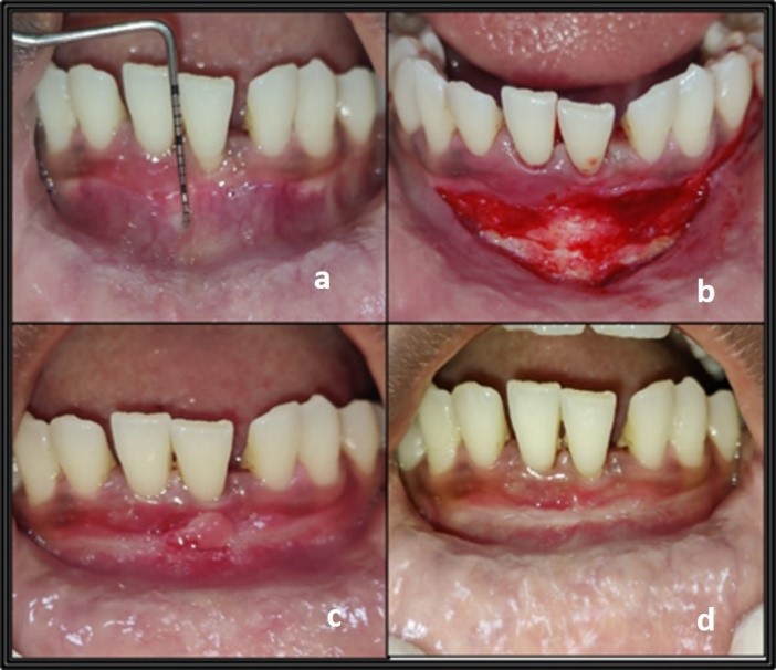 Modified submucosal vestibuloplasty without sutures; a: pre-operative view; b: Supraperiosteal dissection and scoring done; c: One-week post-operative view showing scar tissue formation; d: 21 days post-operative view