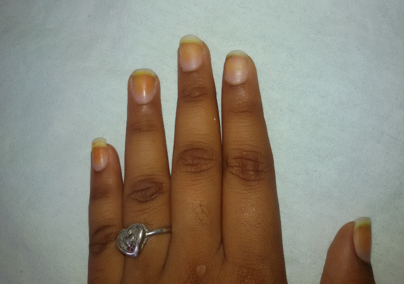 Orange chromonychia (exogenous due to henna)