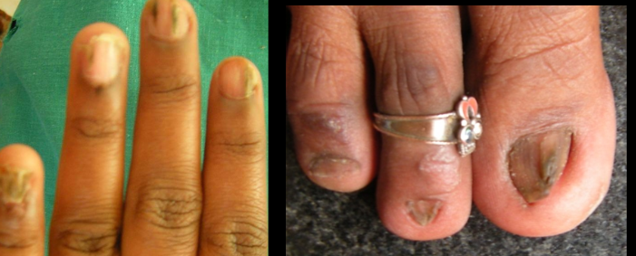 Melanonychia due to lichen planus