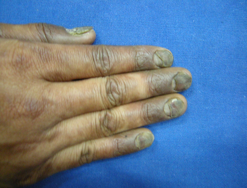 Melanonychia due to pemphigus with onychomadesis