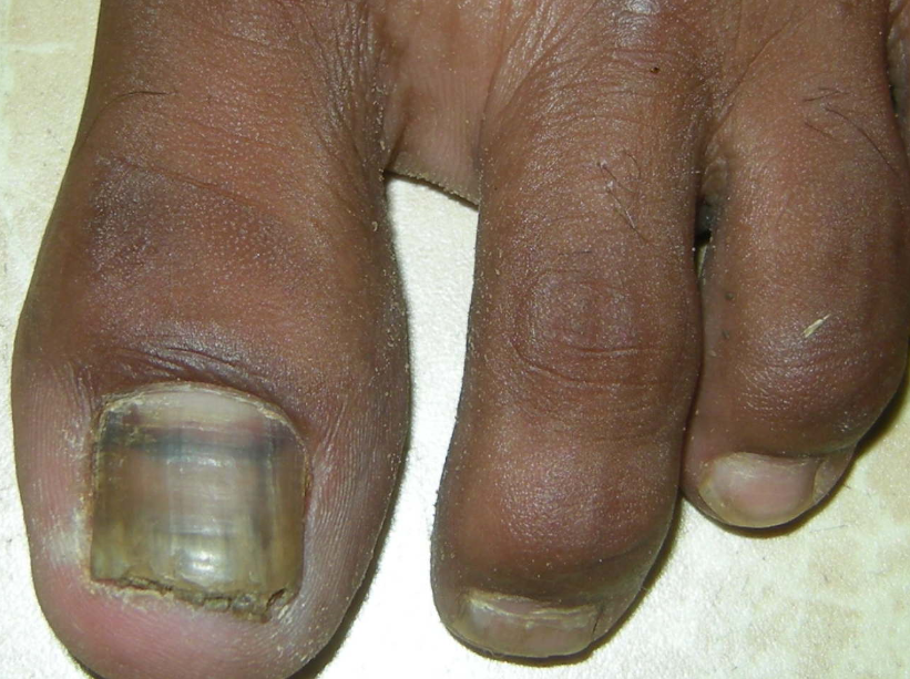Systemic lupus erythematosus and antimalarial induced pigmentation
