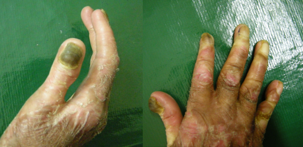 Melonachia in Dystrophic epidermolysis bullosa patient
