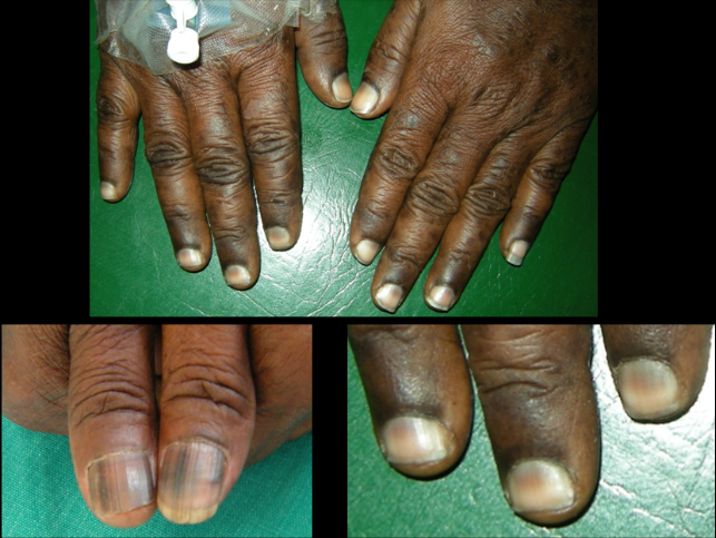 Bleomycyin induced nail pigmentation