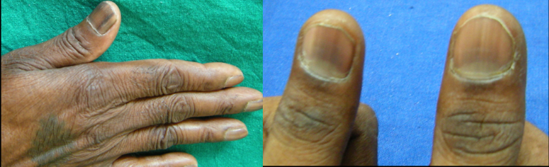 Melanonychia in HIV patient