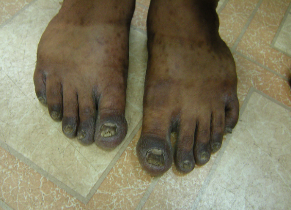 Melanonychia in psoriasis