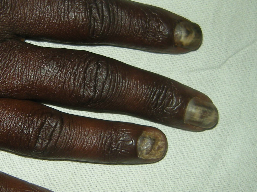 Fungal melanonychia