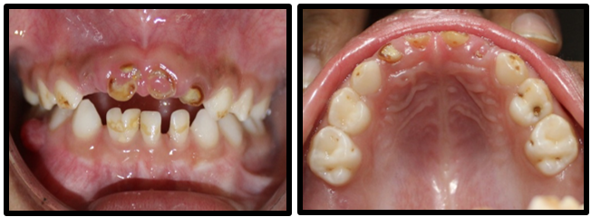 Showing grossly carious 51,52,61,62