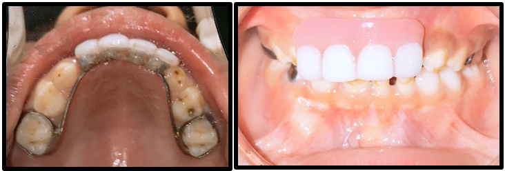 Postoperative photograph after the placement of appliance