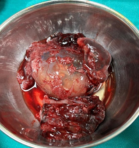 Intact gestational sac, surrounded by ovarian mass
