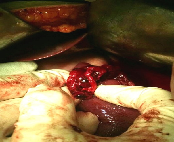 Shows a 3x2 cm mass attached to superolateral surface of spleen with bleeding at its site of attachment