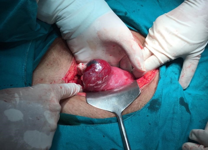 Shows interstitial ectopic pregnancy