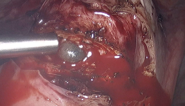 Shows G-sac attached in lower uterine segment along with bladder adhesions