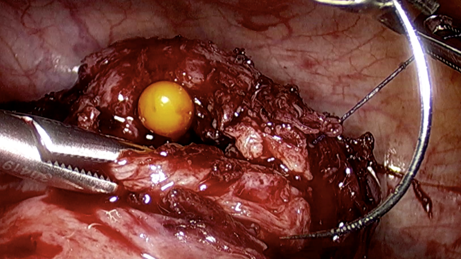 Showing closure of uterine walls after resection of scar ectopic pregnancy