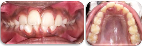 Post operative view showing 11 alignment