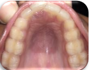 Thermoform retainer delivered