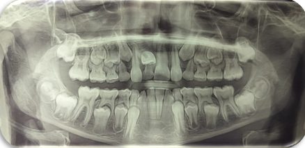 OPG showing ectopic eruption of 11