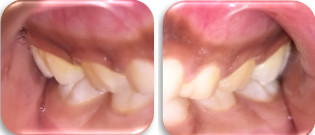 Bilateral Angle’s class1 molar relation