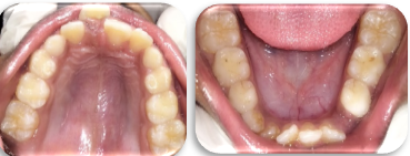 Pretreatment occlusal view of upper and lower arch