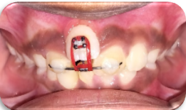 Chain elastics replaced with red orthodontic elastic
