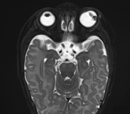 T2-weighted image similarly demonstrated a hypointense lesion in the lateral aspect of the left eye.