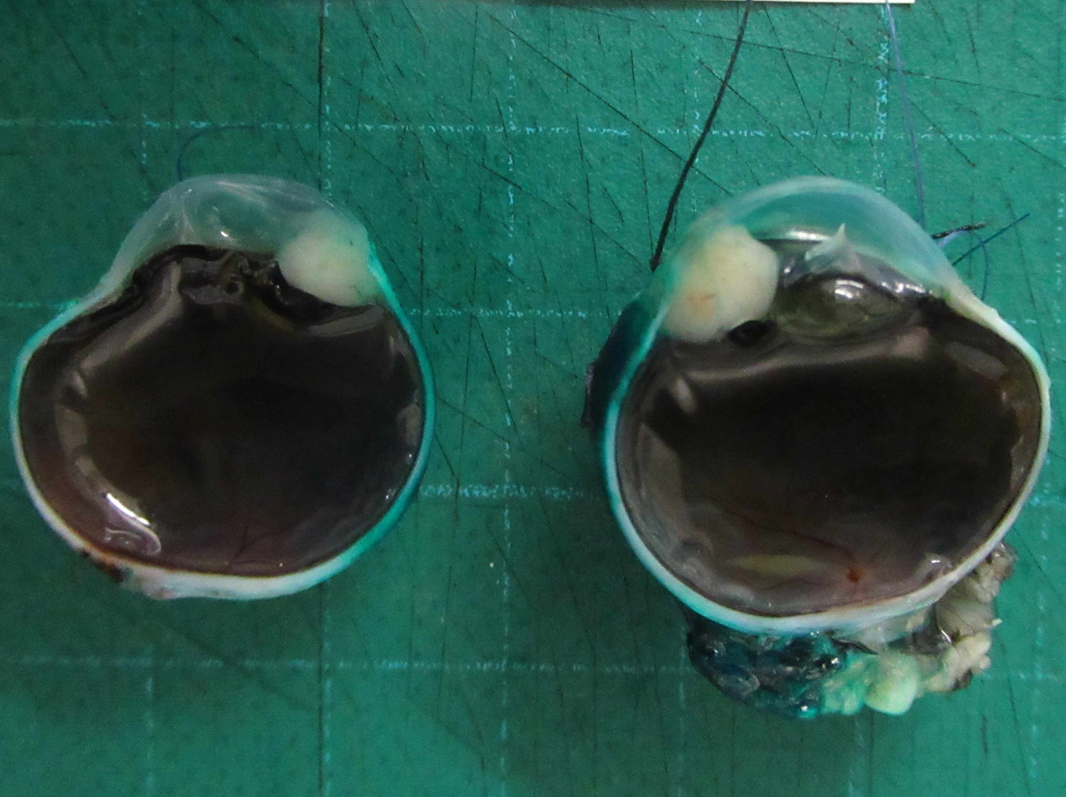 Macroscopic pathology specimen post-enucleation