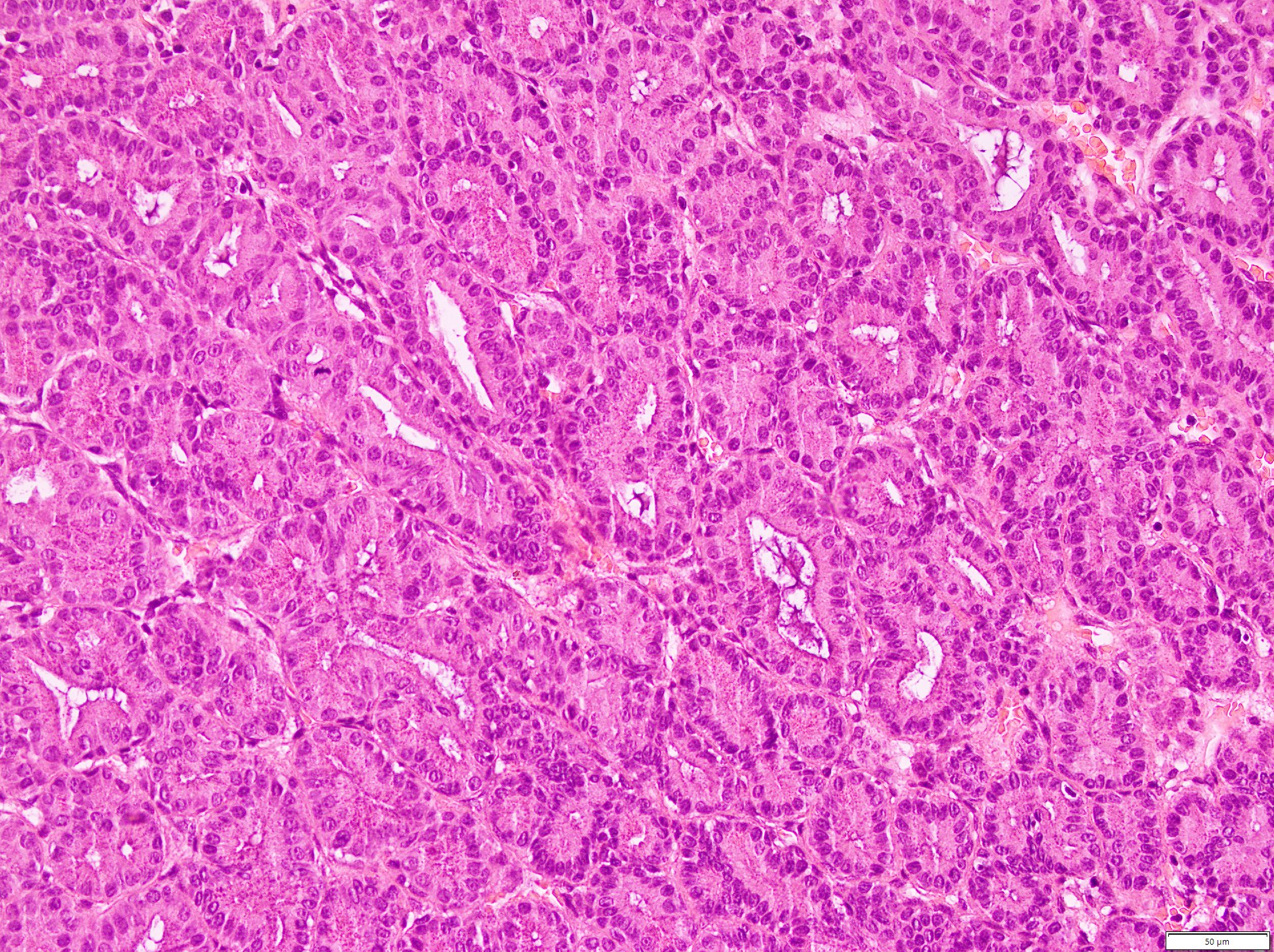 Microscopic pathology specimen post-enucleation