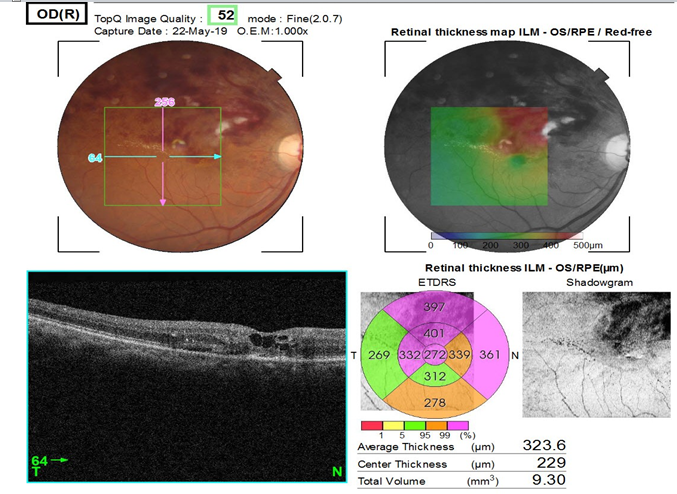 Pre-injection OCT showing central macular thickness of BRVO patient