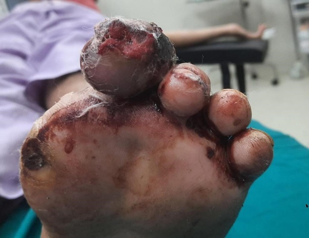 Left second toe wound infection