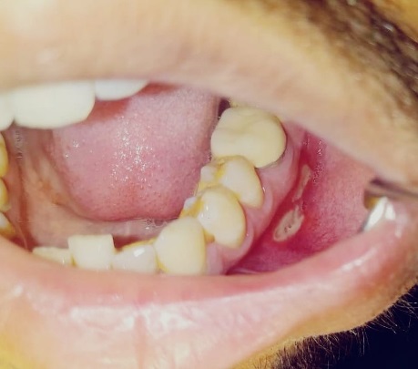 Two large elliptical ulcers on the left lower buccal vestibule.