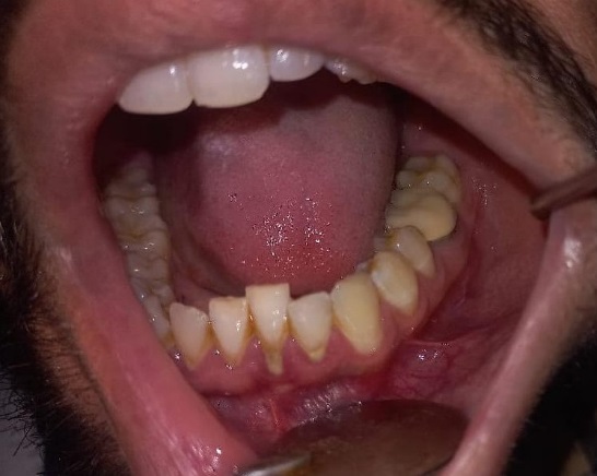 Completely healed ulcers.