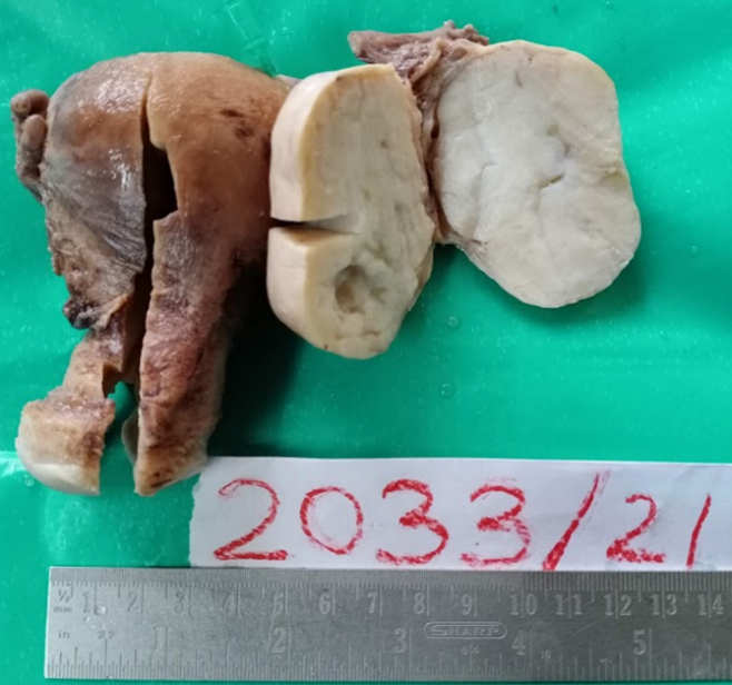Photograph of the right ovarian mass with grey-white to yellowish, solid cut surface with focal cystic spaces