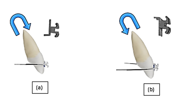 Root movements (torque expression) after activation of BaTR bracket legs