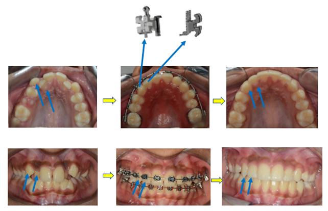 Use of BaTR Bracket in a buccally positioned upper canines, palatally positioned upper lateral incisors and post treatment changes