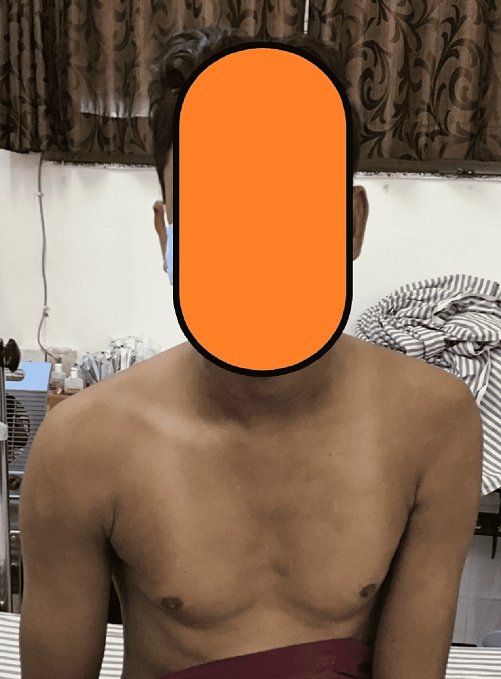 Pre-operative clinical picture showing wasting of the deltoid and other shoulder muscles due to disuse atrophy