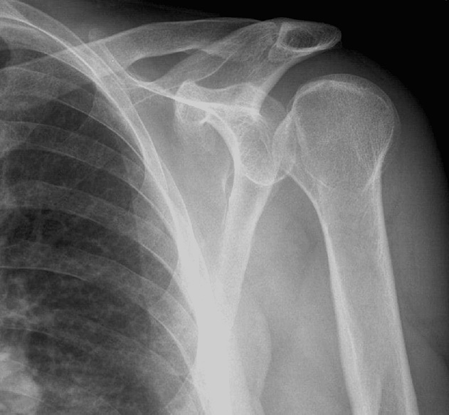 Preoperative posterior dislocation shoulder x ray