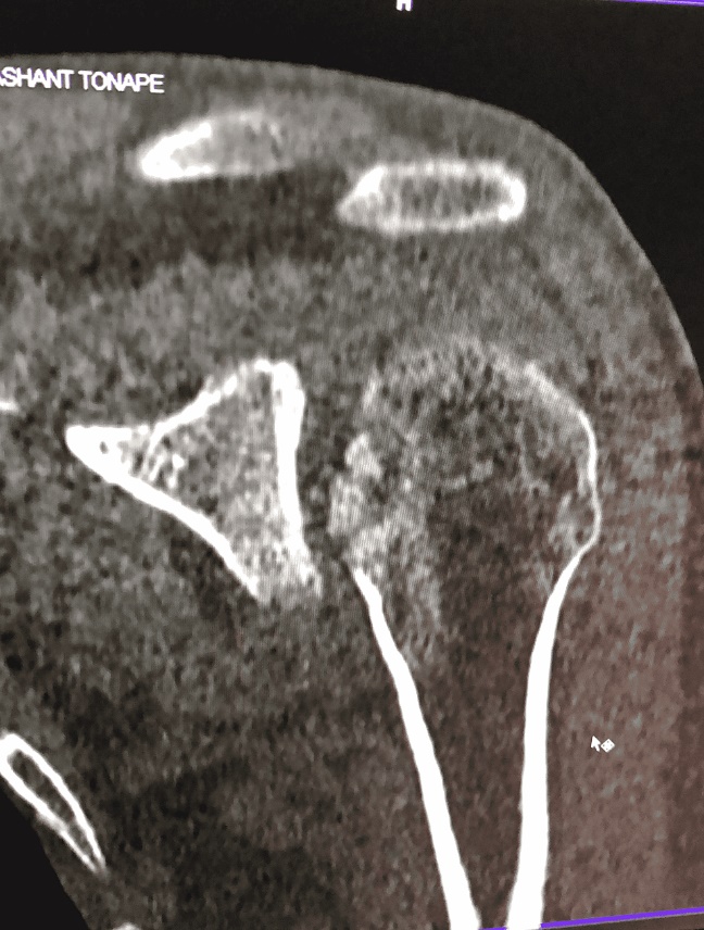 CT scan section showing impaction fracture in posterior shoulder locked dislocation