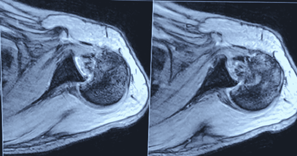 MRI axial Sections showing posterior locked dislocation with reverse Hill Sachs defect