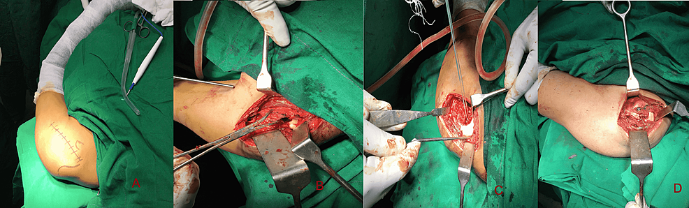 Modified Mc Laughlin surgical procedureA): Surgical planning to open the shoulder joint through Deltopectoral incision; B): Avulsion fracture of Lesser Tuberosity with Subscapularis insertion; C): A double loaded suture anchor placed into the bed of Reverse Hillsachs lesion; D): Final fixation with Screw and washer after the sutures of the anchor have been tied