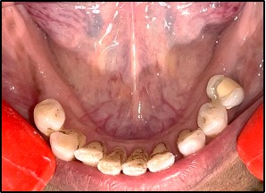 Maxillary arch