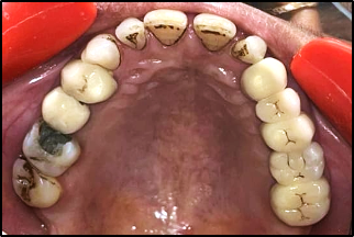 CPD insertion