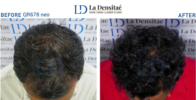 QR678 Neo– before treatment and after 6 months of treatment 