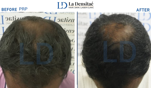 PRP– before treatment and after 6 months of treatment 
