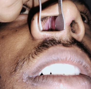 Clinical pic of the patient: Anterior rhinoscopy