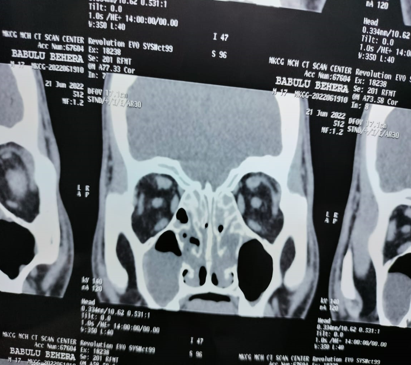 CT scan of PNS showing the unilateral mass with blocked Osteomeatal complex and Pan sinusitits