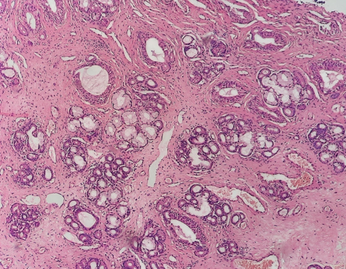 LP 100X-subepithelial tissue showing proliferation of seromucinous glands, blood vessels, fibrous tissue