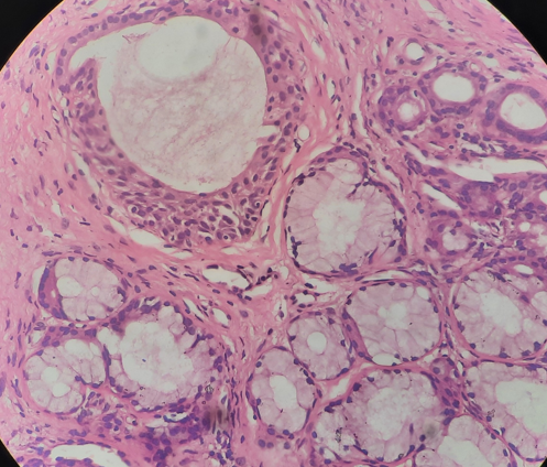 LP100x-Showing mucinous glands some lined by pseudo stratified columnar epithelium.